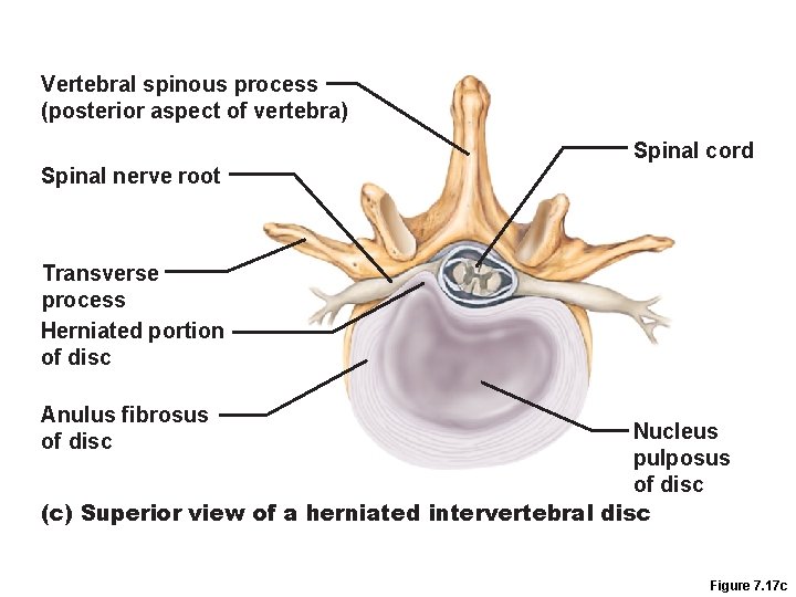 Vertebral spinous process (posterior aspect of vertebra) Spinal cord Spinal nerve root Transverse process