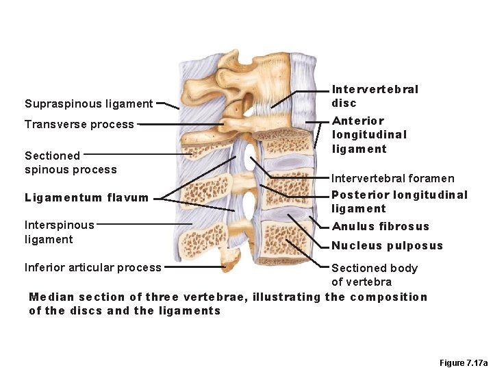 Supraspinous ligament Transverse process Sectioned spinous process Ligamentum flavum Interspinous ligament Intervertebral disc Anterior