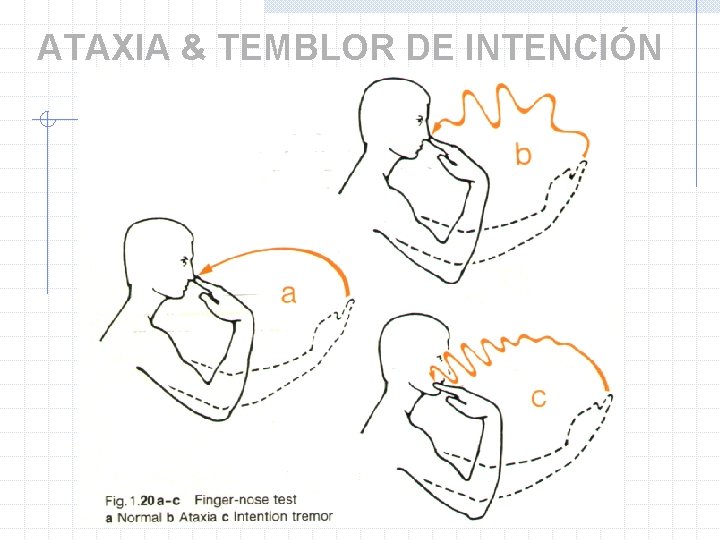 ATAXIA & TEMBLOR DE INTENCIÓN 