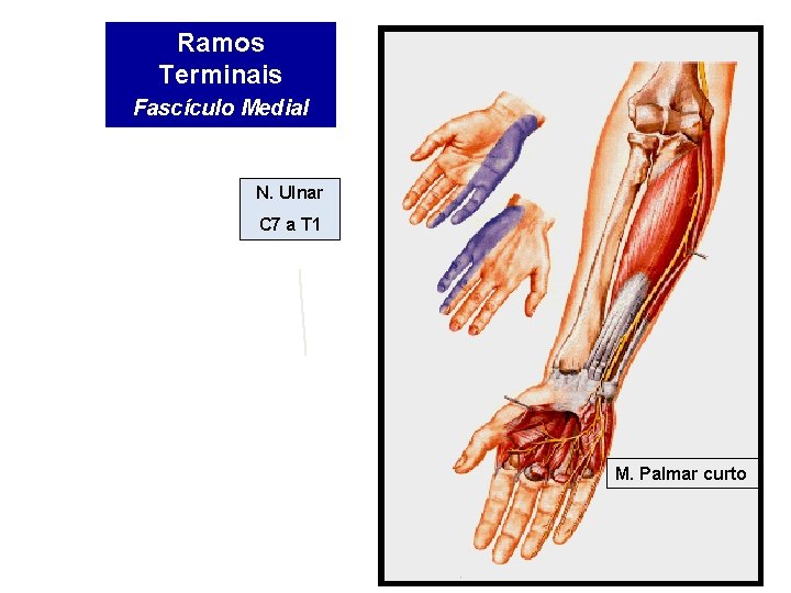 Ramos Terminais Fascículo Medial N. Ulnar C 7 a T 1 M. Palmar curto