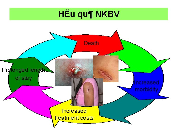 HËu qu¶ NKBV Death Prolonged length of stay Increased morbidity Increased treatment costs 