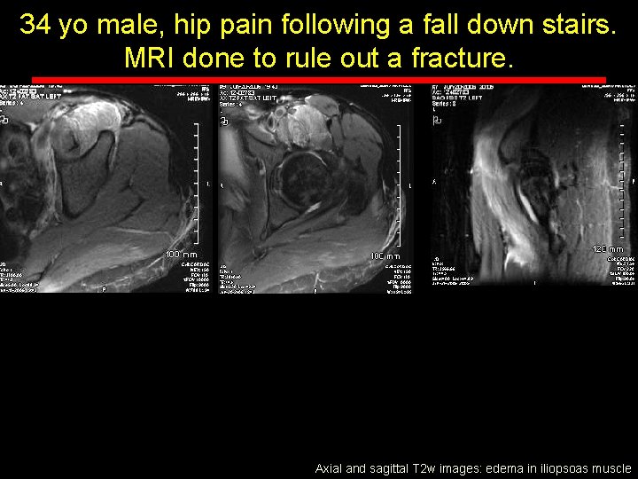 34 yo male, hip pain following a fall down stairs. MRI done to rule