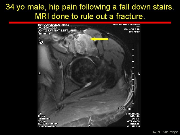 34 yo male, hip pain following a fall down stairs. MRI done to rule