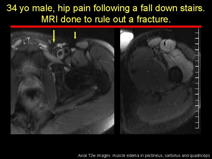 34 yo male, hip pain following a fall down stairs. MRI done to rule