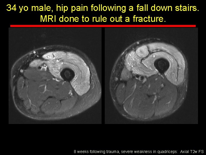 34 yo male, hip pain following a fall down stairs. MRI done to rule