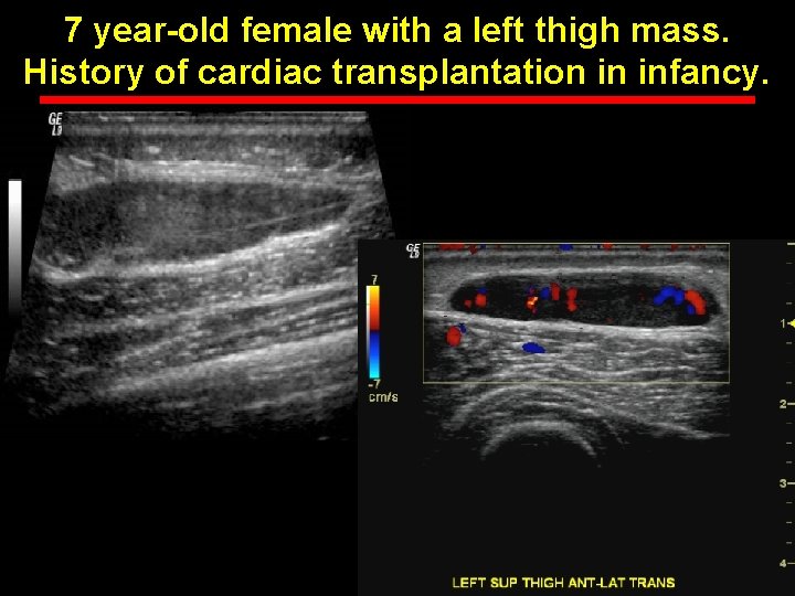 7 year-old female with a left thigh mass. History of cardiac transplantation in infancy.