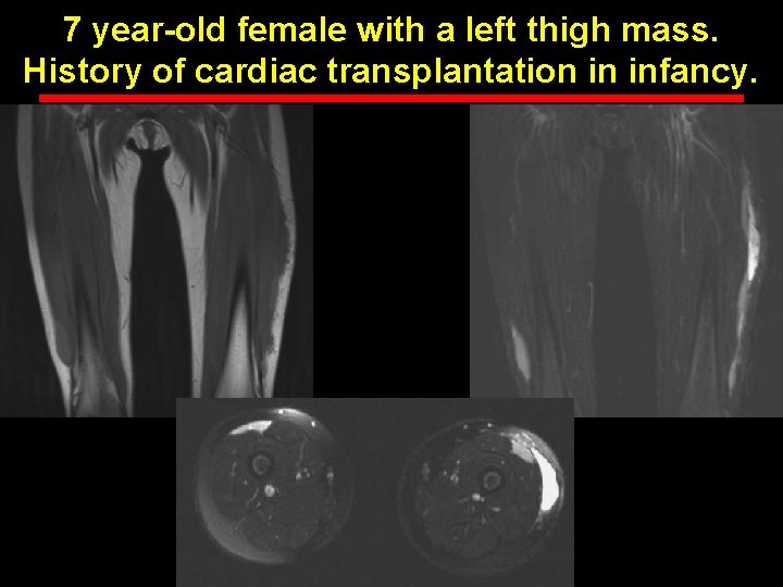 7 year-old female with a left thigh mass. History of cardiac transplantation in infancy.