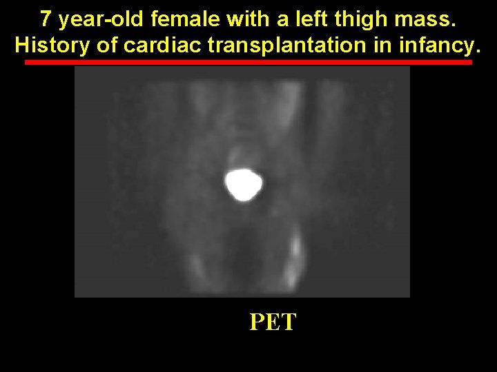 7 year-old female with a left thigh mass. History of cardiac transplantation in infancy.