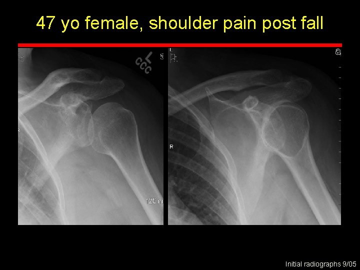 47 yo female, shoulder pain post fall Initial radiographs 9/05 