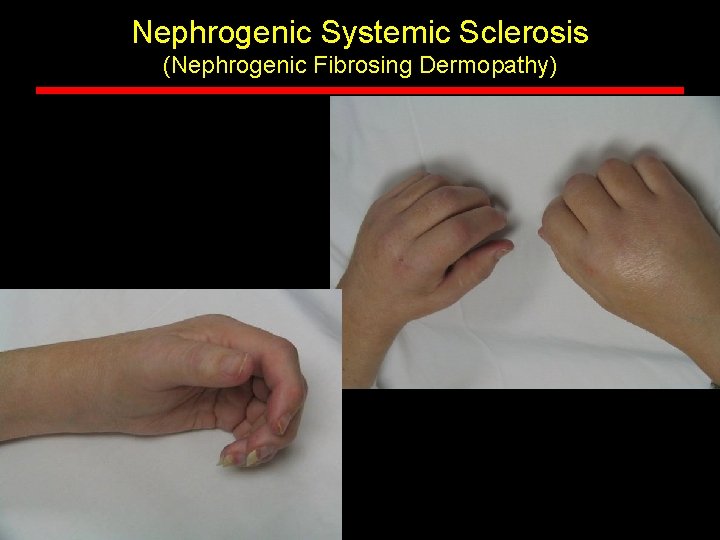 Nephrogenic Systemic Sclerosis (Nephrogenic Fibrosing Dermopathy) 