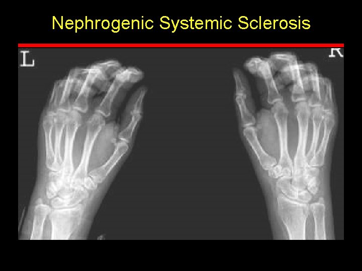 Nephrogenic Systemic Sclerosis 