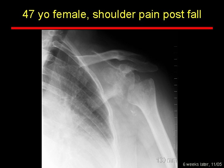 47 yo female, shoulder pain post fall 6 weeks later, 11/05 