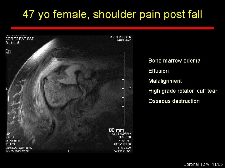 47 yo female, shoulder pain post fall Bone marrow edema Effusion Malalignment High grade