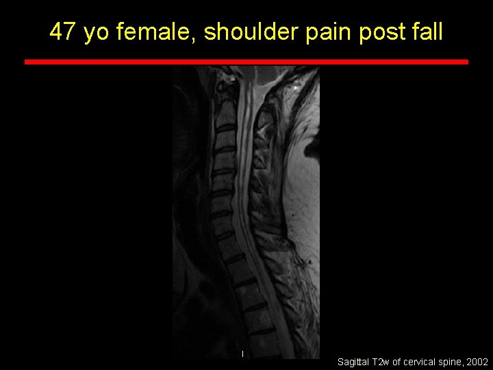 47 yo female, shoulder pain post fall Sagittal T 2 w of cervical spine,