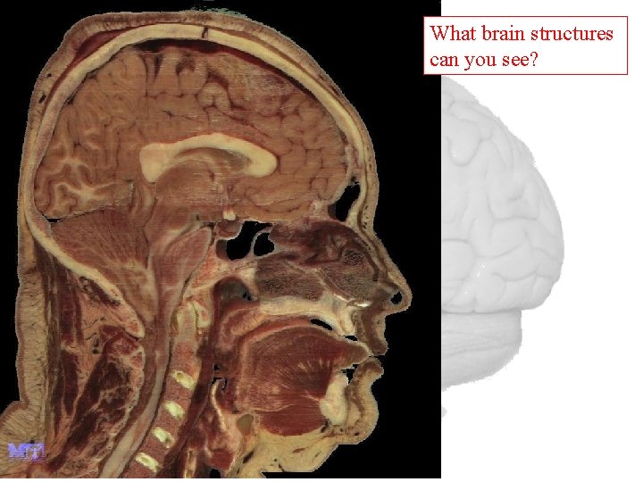 What brain structures can you see? 