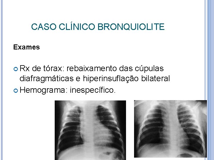 CASO CLÍNICO BRONQUIOLITE Exames Rx de tórax: rebaixamento das cúpulas diafragmáticas e hiperinsuflação bilateral