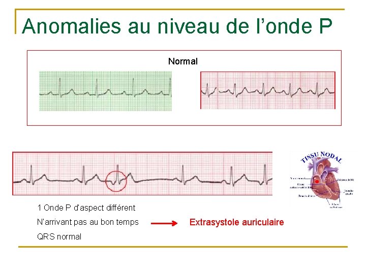 Anomalies au niveau de l’onde P Normal 1 Onde P d’aspect différent N’arrivant pas