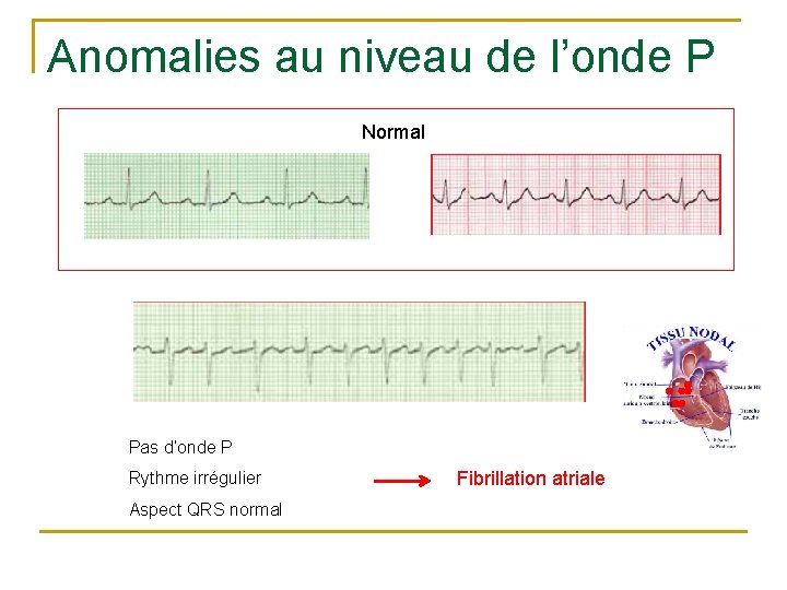 Anomalies au niveau de l’onde P Normal Pas d’onde P Rythme irrégulier Aspect QRS