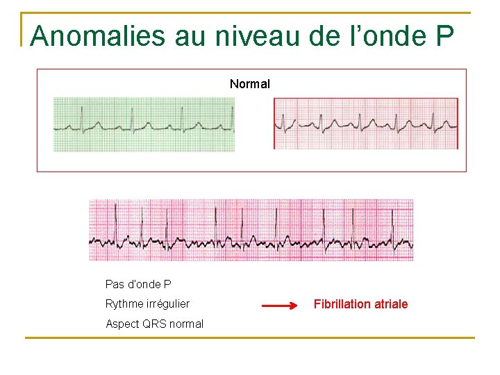 Anomalies au niveau de l’onde P Normal Pas d’onde P Rythme irrégulier Aspect QRS