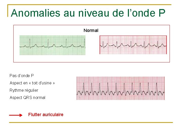 Anomalies au niveau de l’onde P Normal Pas d’onde P Aspect en « toit