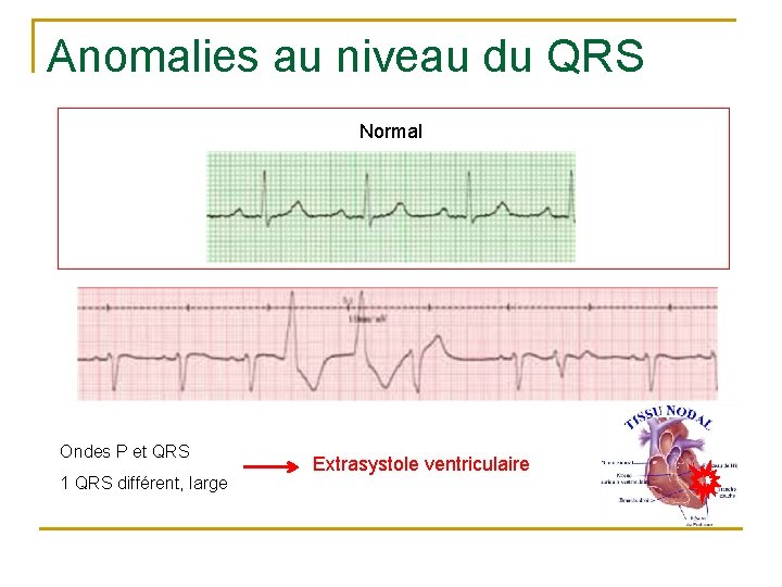 Anomalies au niveau du QRS Normal Ondes P et QRS 1 QRS différent, large