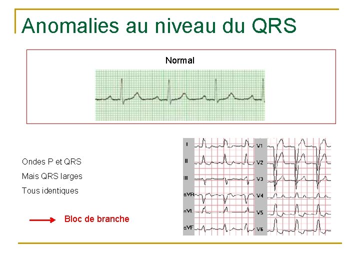 Anomalies au niveau du QRS Normal Ondes P et QRS Mais QRS larges Tous