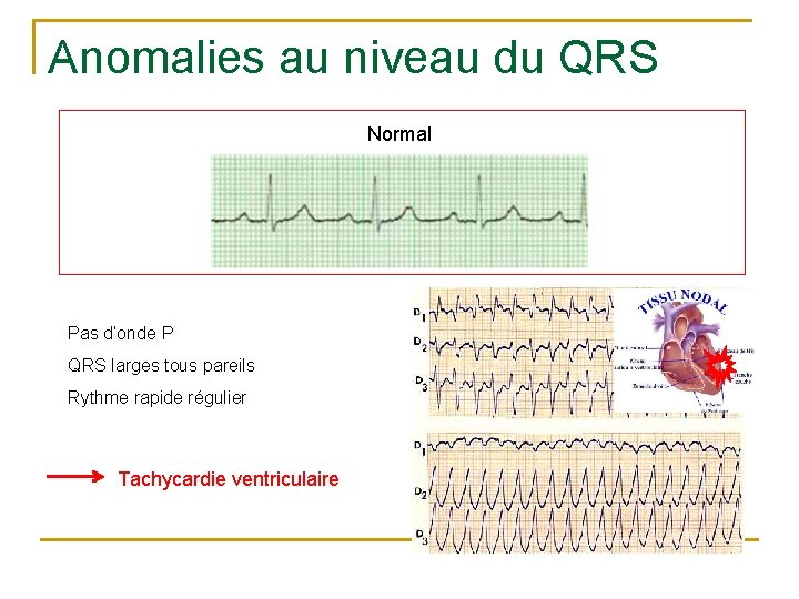 Anomalies au niveau du QRS Normal Pas d’onde P QRS larges tous pareils Rythme