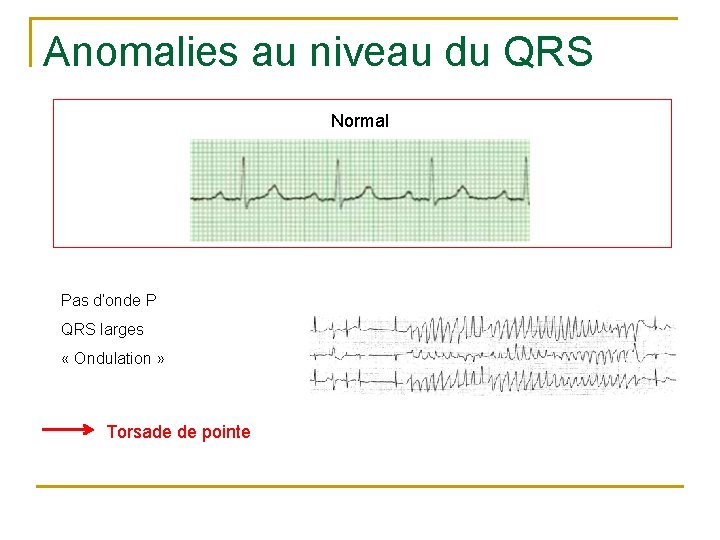 Anomalies au niveau du QRS Normal Pas d’onde P QRS larges « Ondulation »