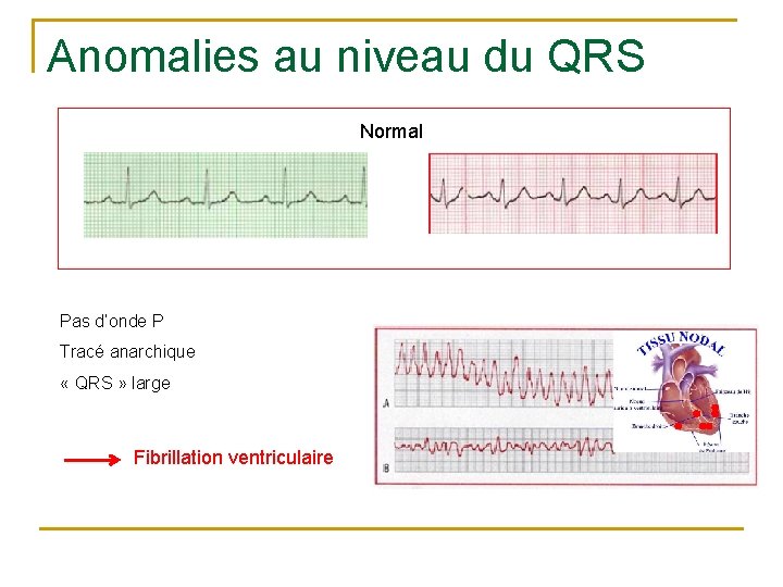 Anomalies au niveau du QRS Normal Pas d’onde P Tracé anarchique « QRS »