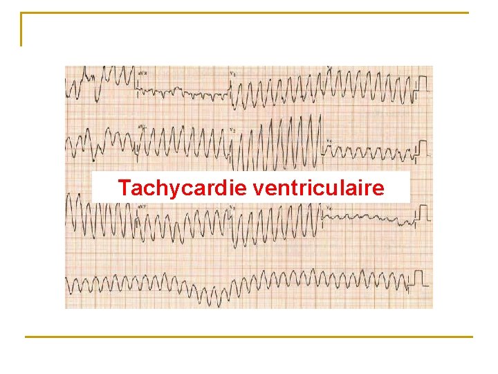 Tachycardie ventriculaire 