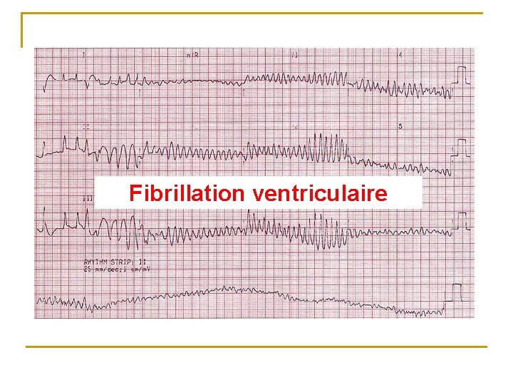 Fibrillation ventriculaire 