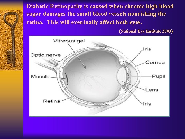 Diabetic Retinopathy is caused when chronic high blood sugar damages the small blood vessels