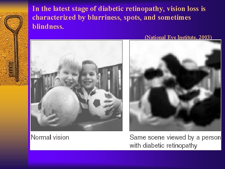 In the latest stage of diabetic retinopathy, vision loss is characterized by blurriness, spots,