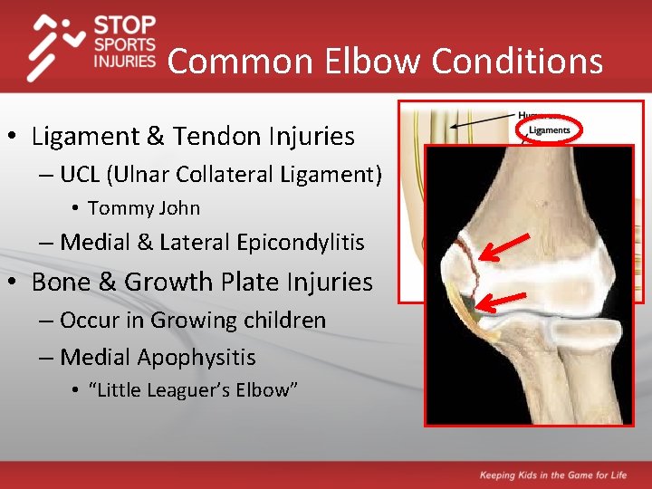 Common Elbow Conditions • Ligament & Tendon Injuries – UCL (Ulnar Collateral Ligament) •