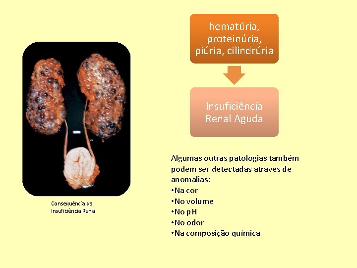 hematúria, proteinúria, piúria, cilindrúria Insuficiência Renal Aguda Consequência da Insuficiência Renal Algumas outras patologias