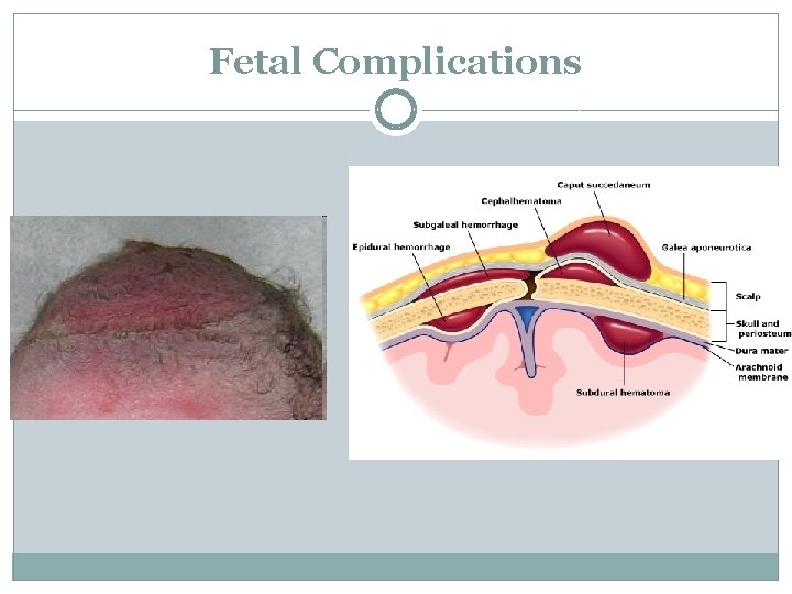 Fetal Complications 