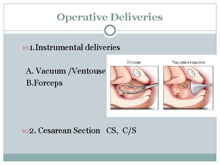 Operative Deliveries 1. Instrumental deliveries A. Vacuum /Ventouse B. Forceps 2. Cesarean Section CS,
