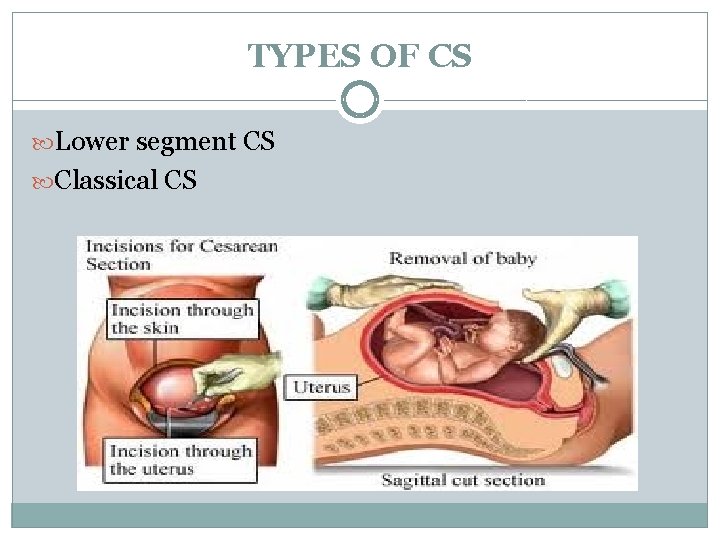 TYPES OF CS Lower segment CS Classical CS 