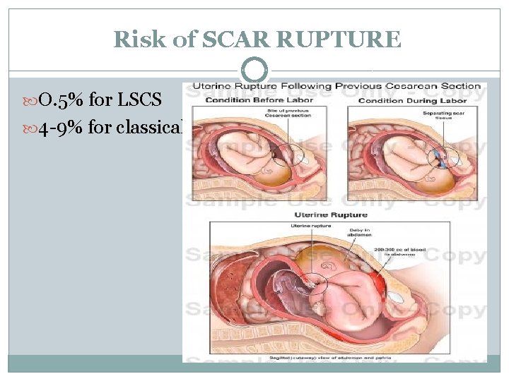 Risk of SCAR RUPTURE O. 5% for LSCS 4 -9% for classical 