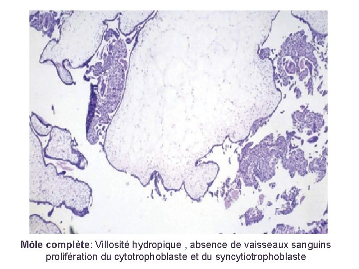 Môle complète: Villosité hydropique , absence de vaisseaux sanguins prolifération du cytotrophoblaste et du