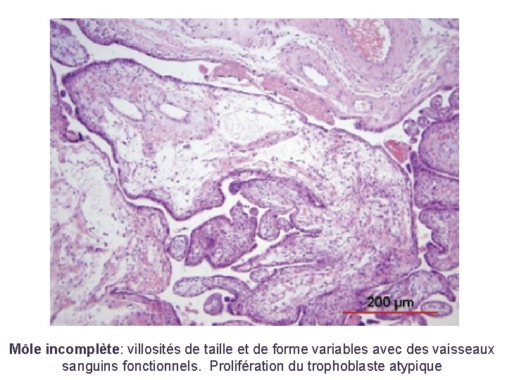 Môle incomplète: villosités de taille et de forme variables avec des vaisseaux sanguins fonctionnels.