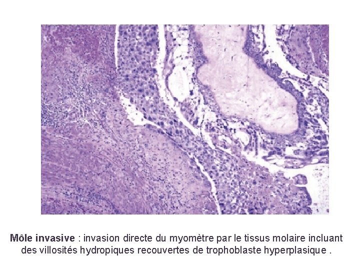 Môle invasive : invasion directe du myomètre par le tissus molaire incluant des villosités
