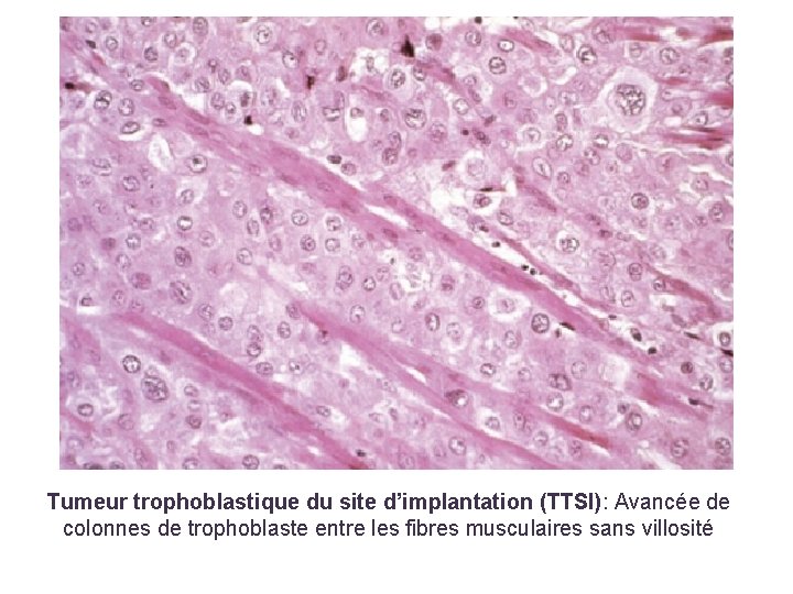 Tumeur trophoblastique du site d’implantation (TTSI): Avancée de colonnes de trophoblaste entre les fibres