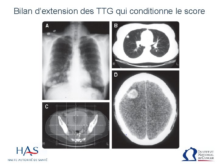 Bilan d’extension des TTG qui conditionne le score 