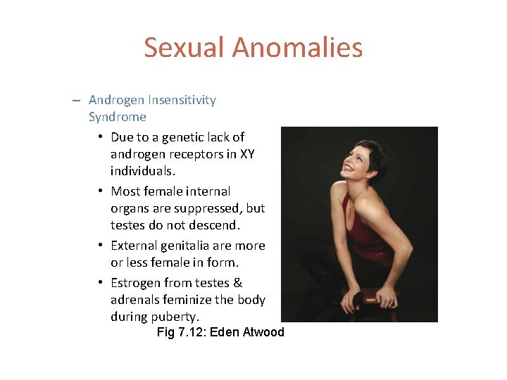 Sexual Anomalies – Androgen Insensitivity Syndrome • Due to a genetic lack of androgen