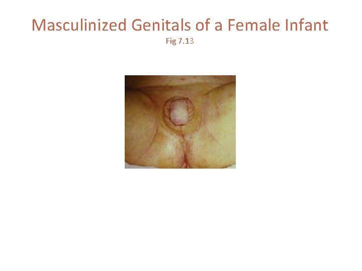 Masculinized Genitals of a Female Infant Fig 7. 13 