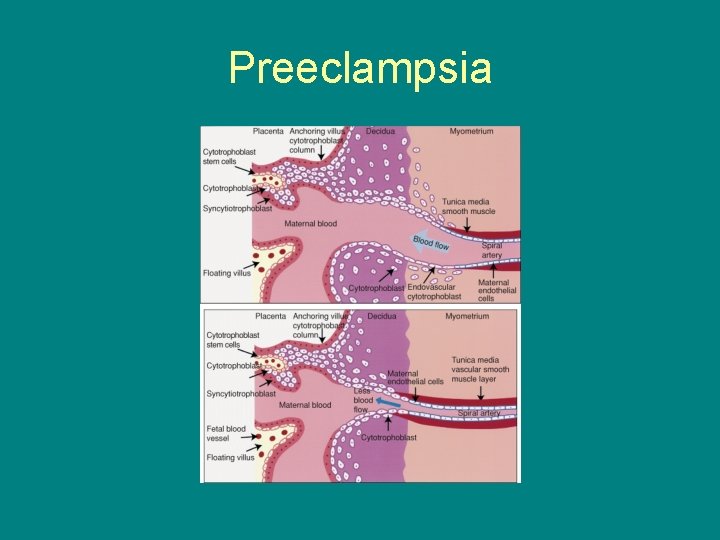 Preeclampsia 