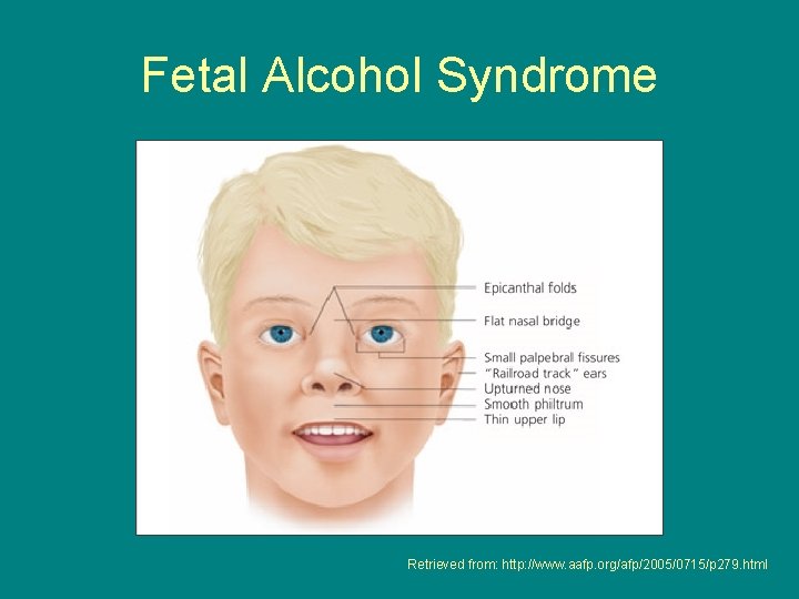Fetal Alcohol Syndrome Retrieved from: http: //www. aafp. org/afp/2005/0715/p 279. html 