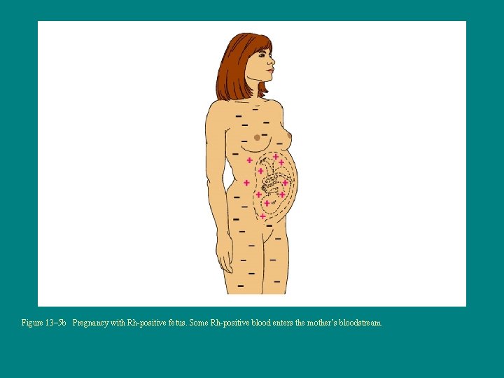 Figure 13– 5 b Pregnancy with Rh-positive fetus. Some Rh-positive blood enters the mother’s