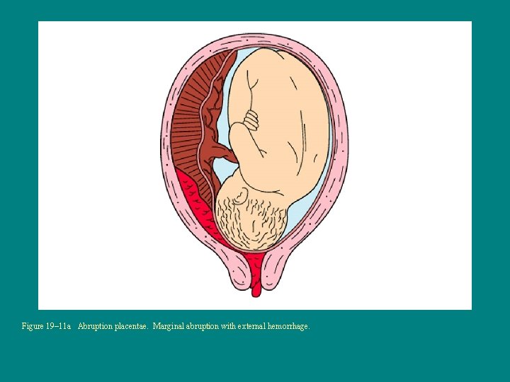 Figure 19– 11 a Abruption placentae. Marginal abruption with external hemorrhage. 